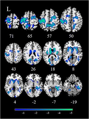 Alterations of Static and Dynamic Functional Connectivity of the Nucleus Accumbens in Patients With Major Depressive Disorder